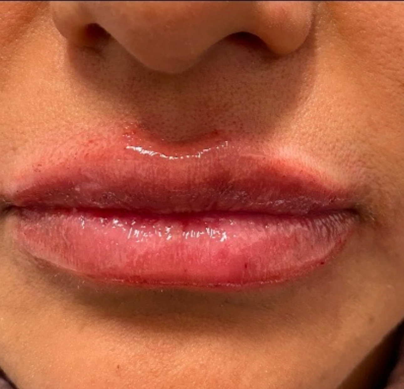 Lip filler after treatment 1