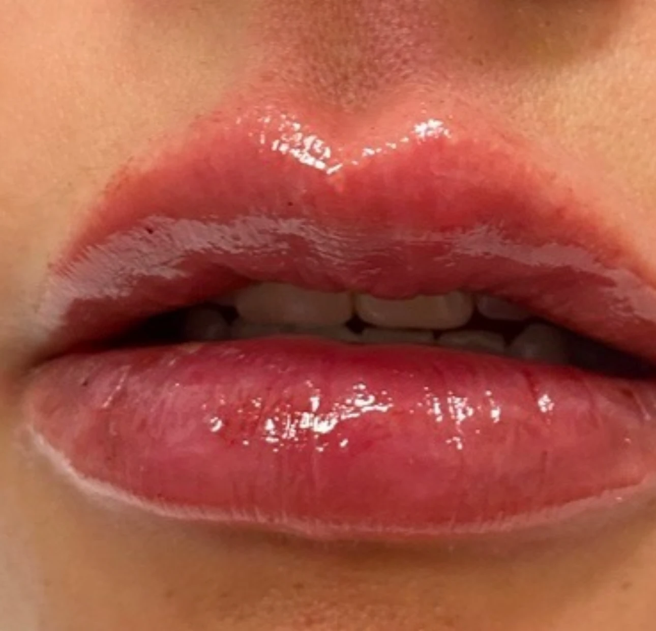 Lip filler after treatment 2