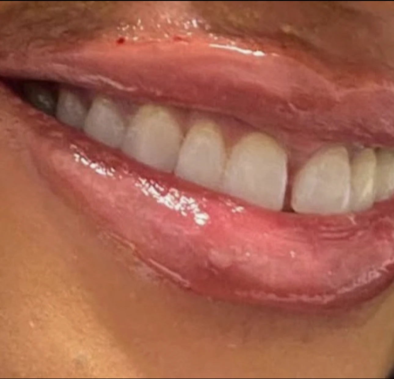 Lip filler after treatment 3