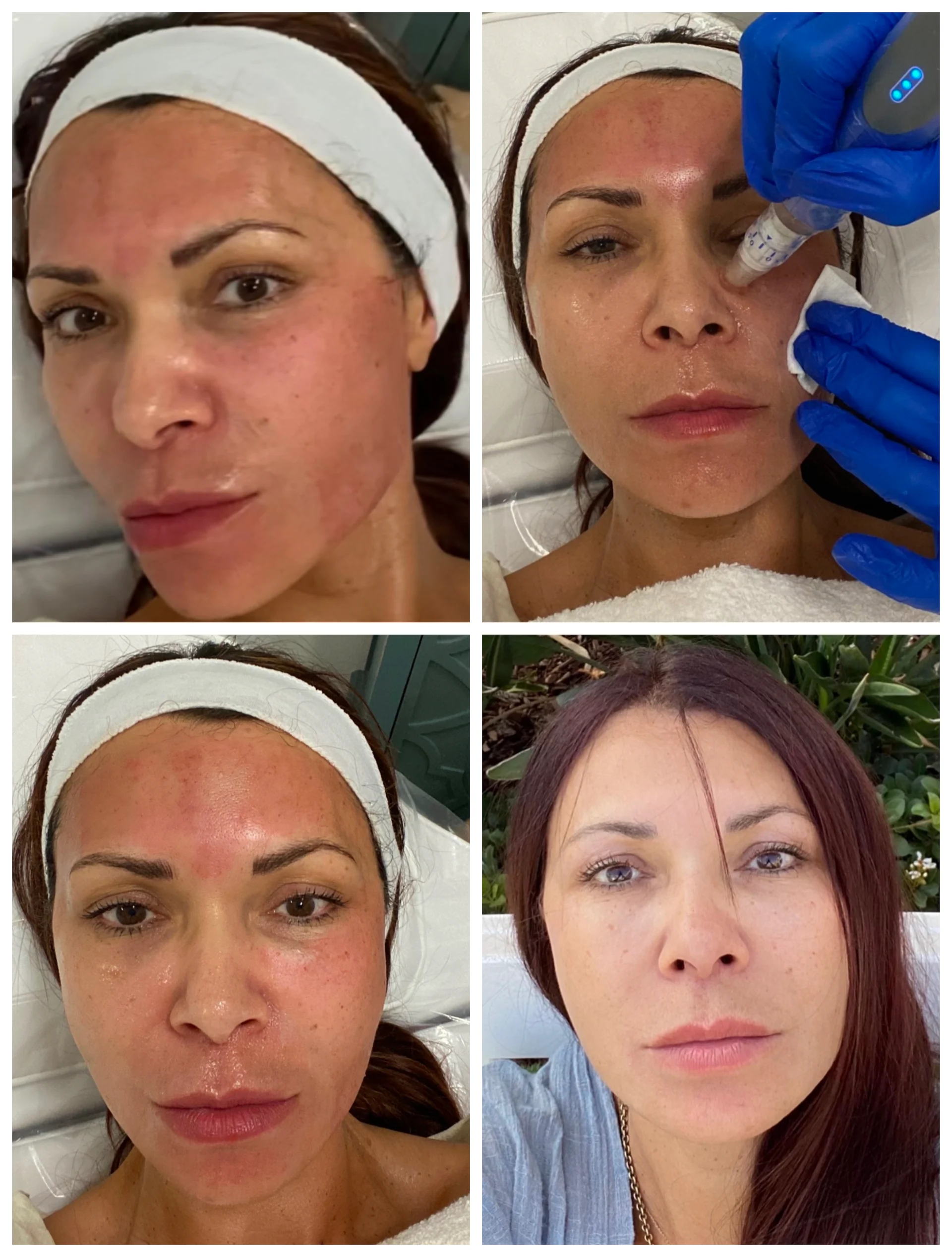 Microneedling treatment results