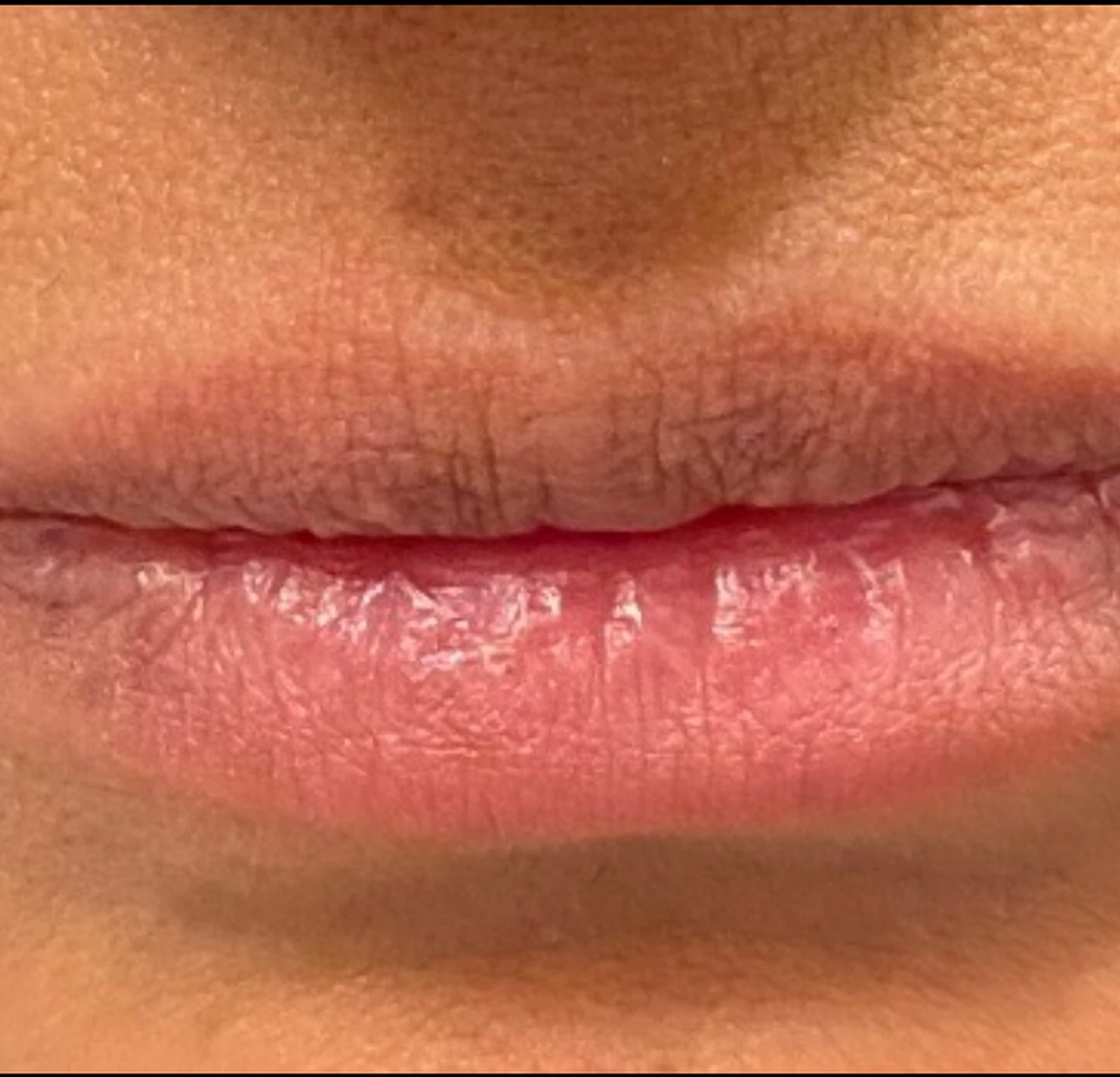 Lip filler before treatment 1