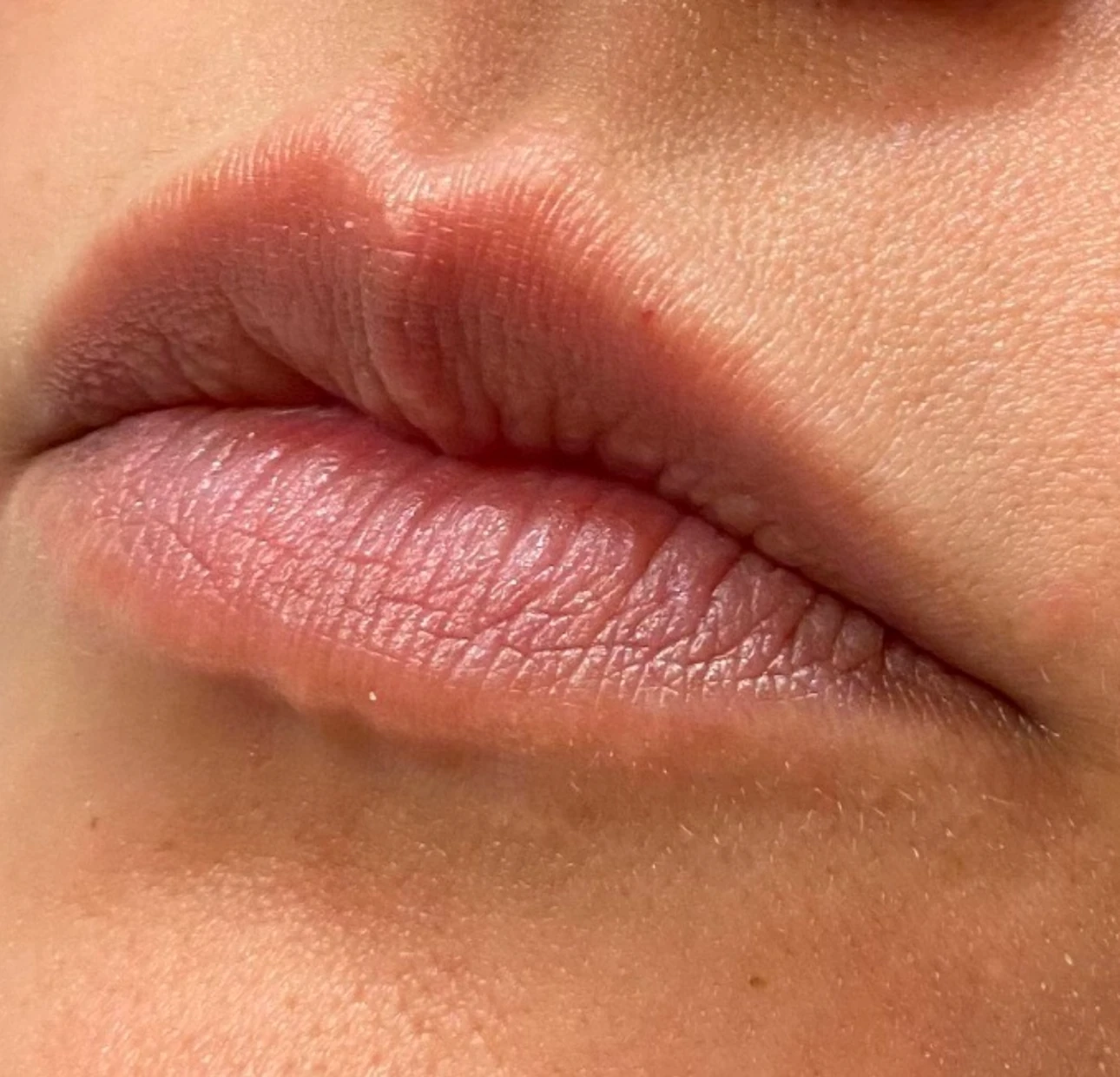 Lip filler before treatment 2