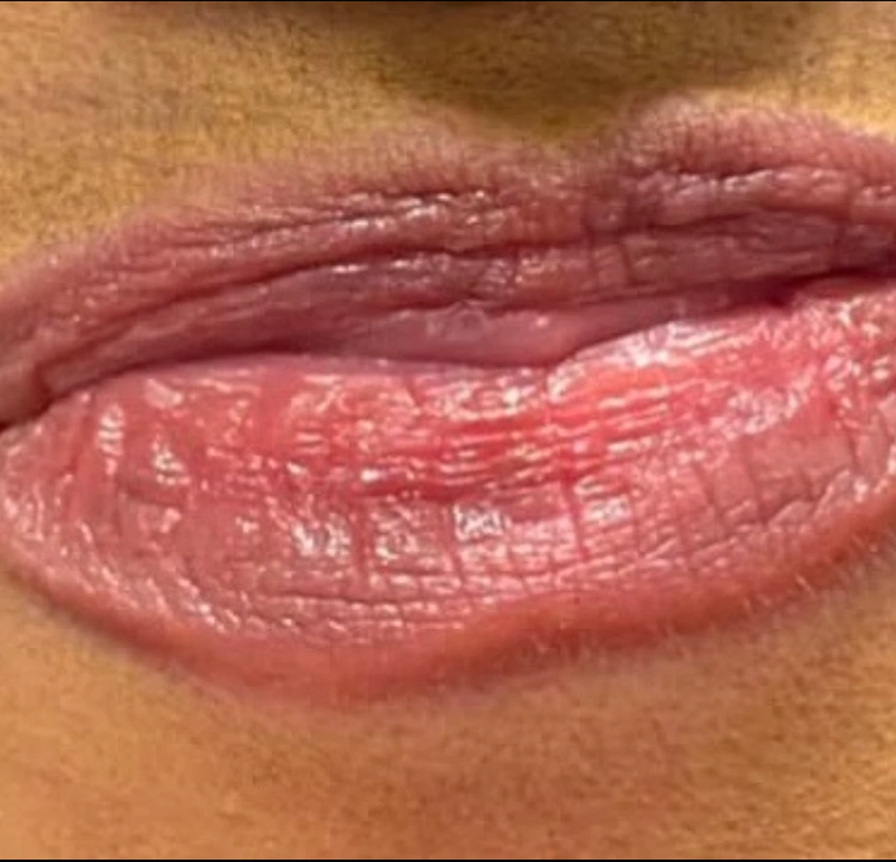 Lip filler before treatment 3