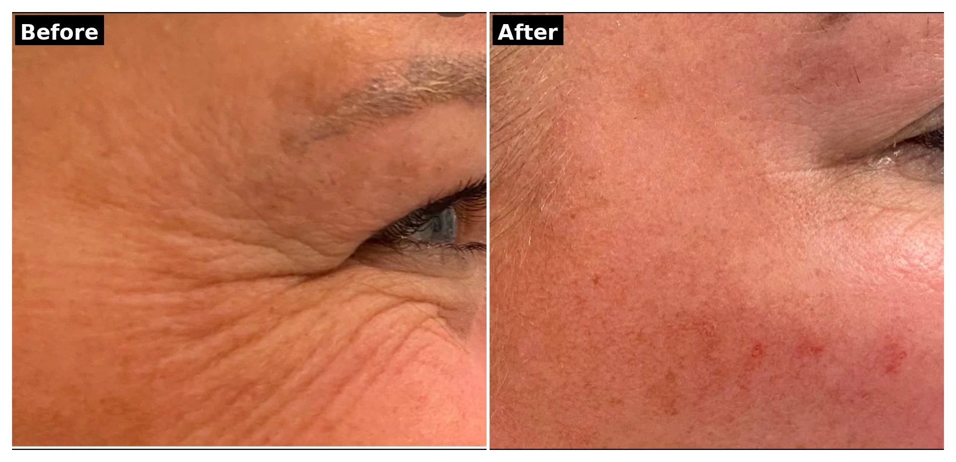 Botox before and after results