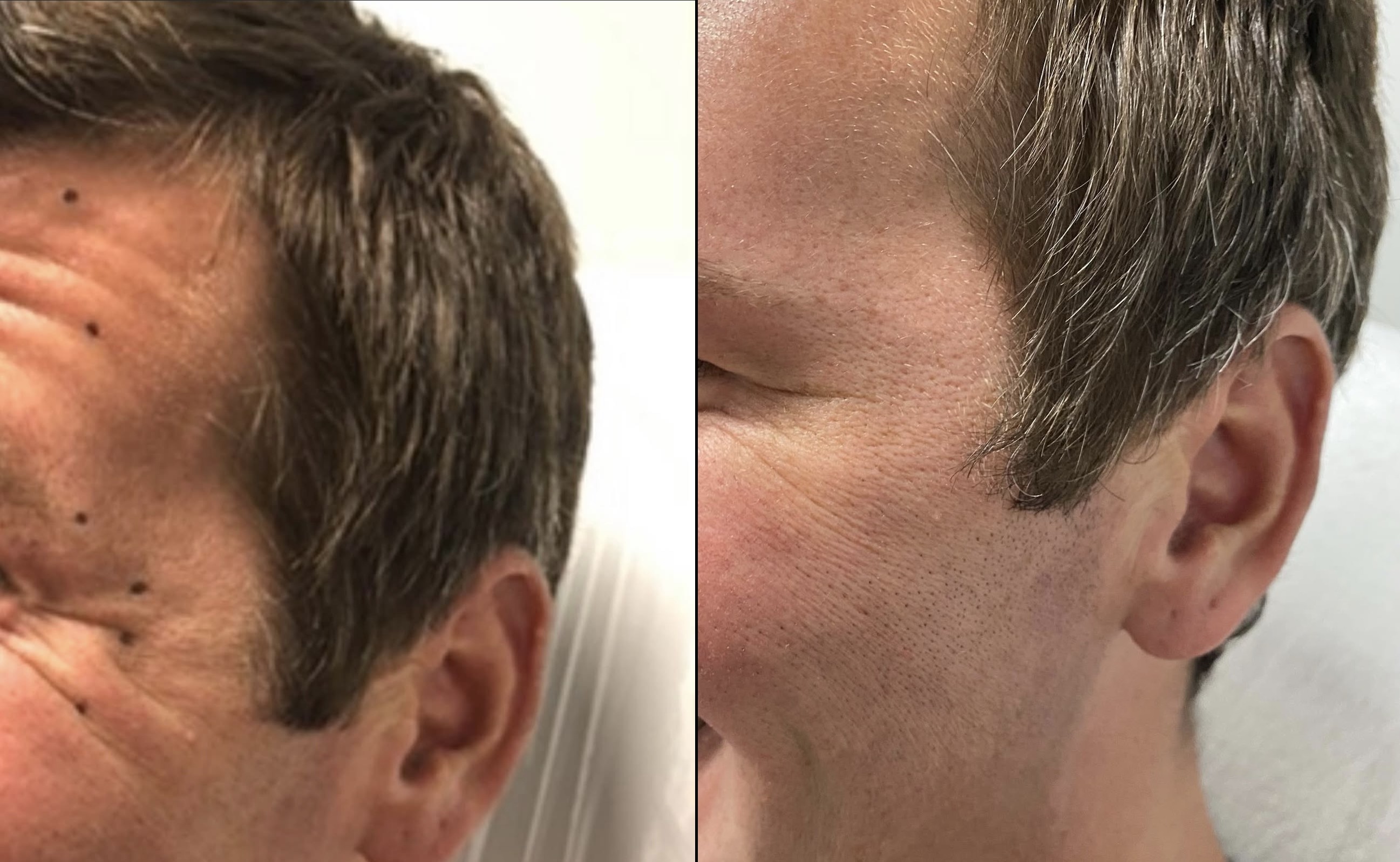 Botox treatment results