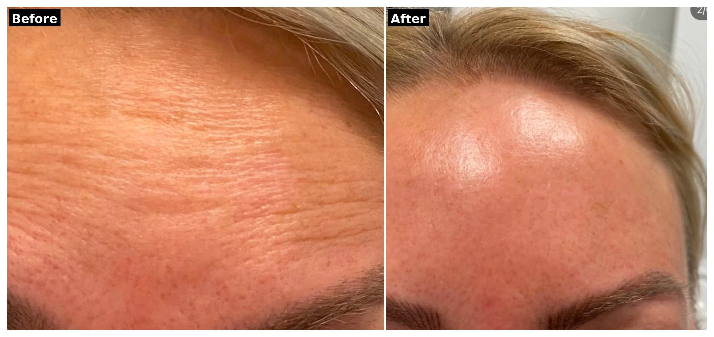 Botox before and after results