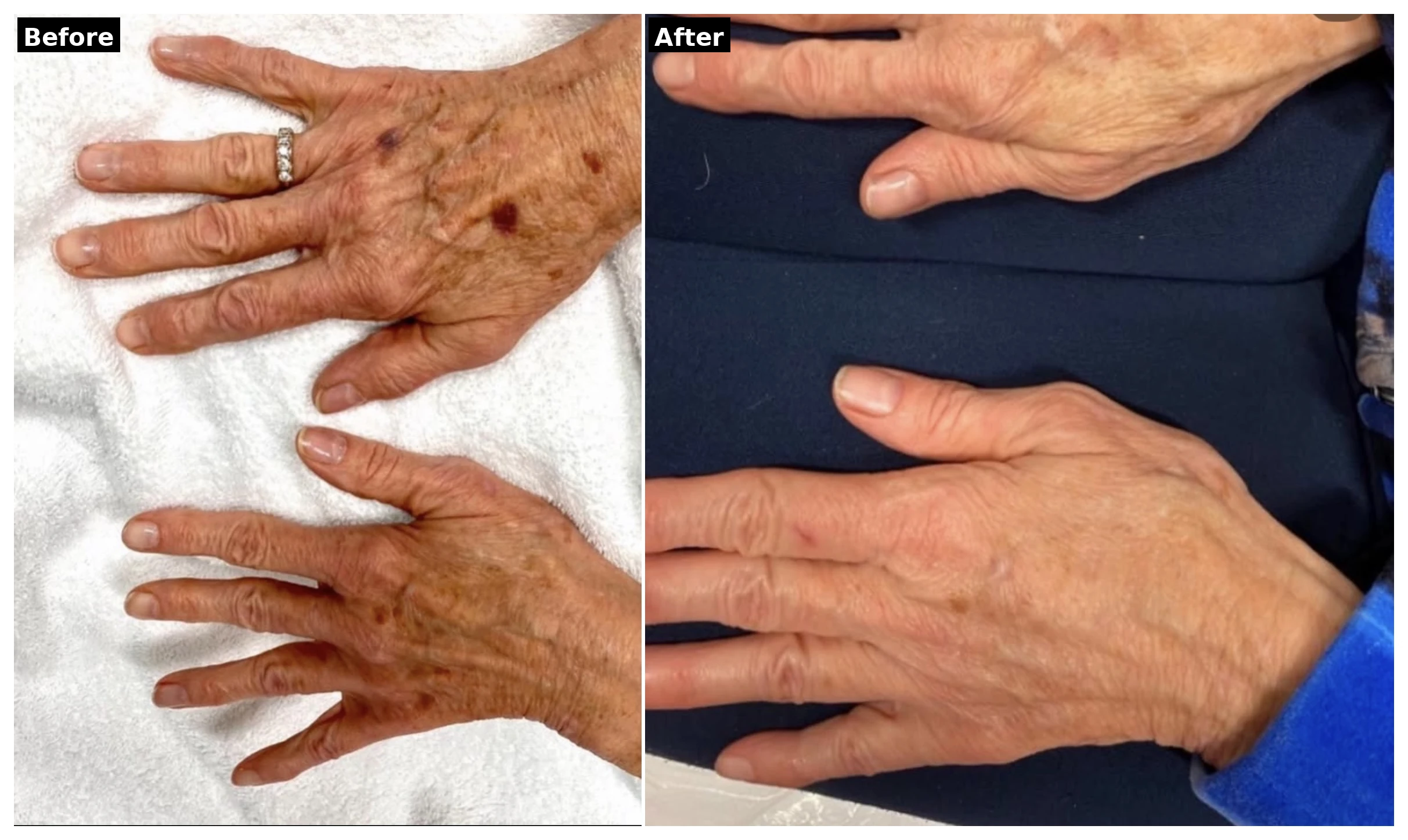 Hand rejuvenation before and after results