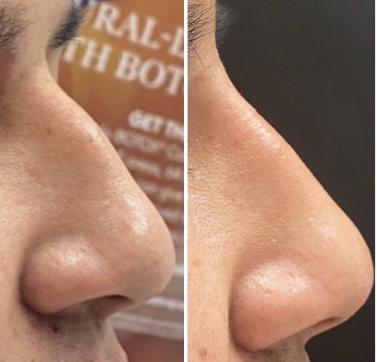 Dermal filler treatment results