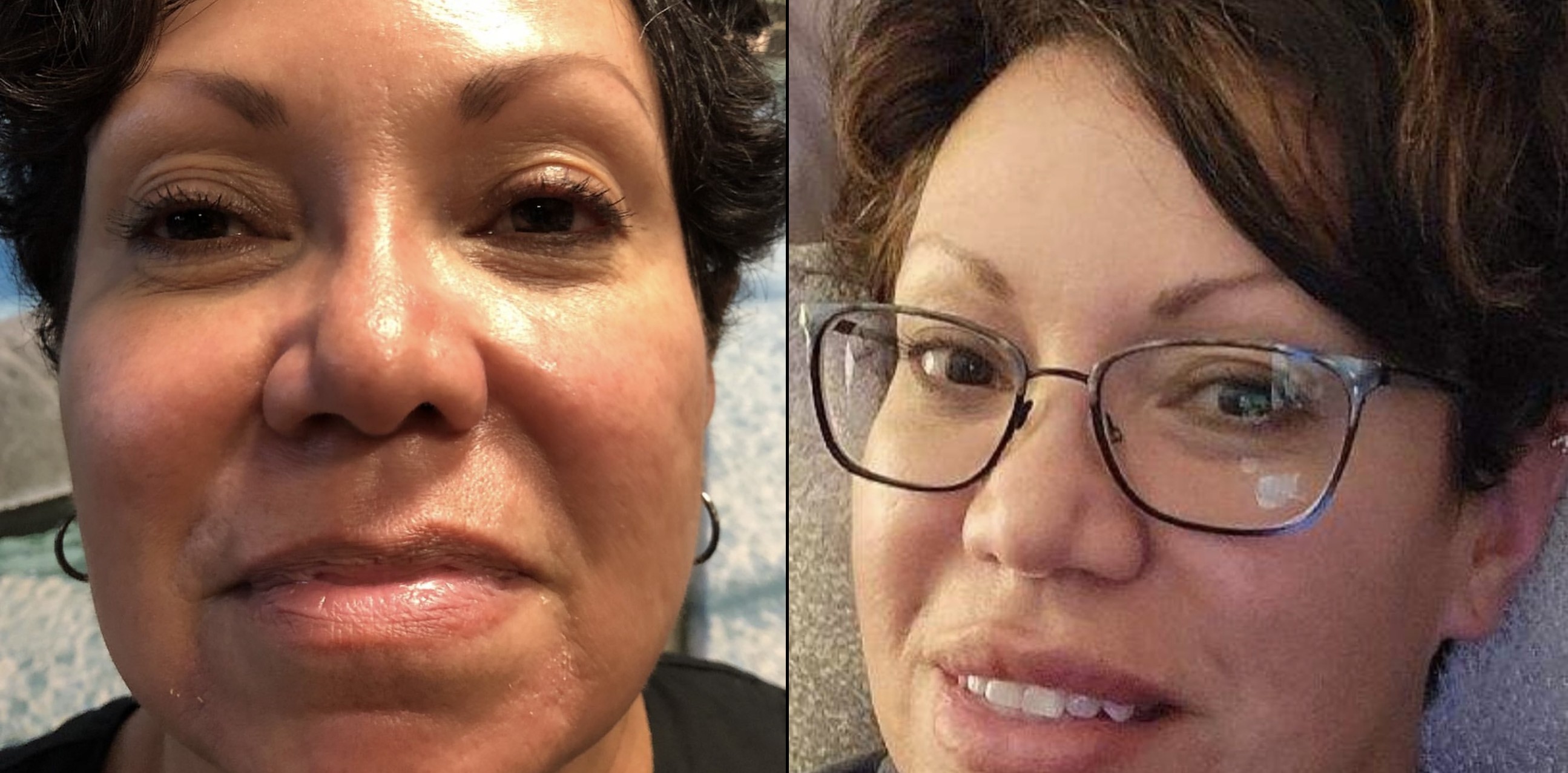 Microneedling treatment results