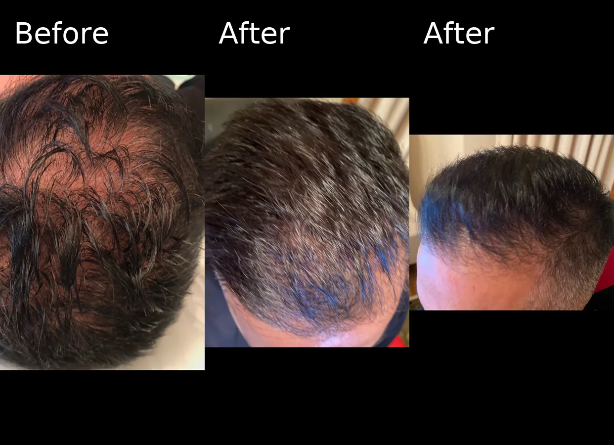 Hair restoration before and after results