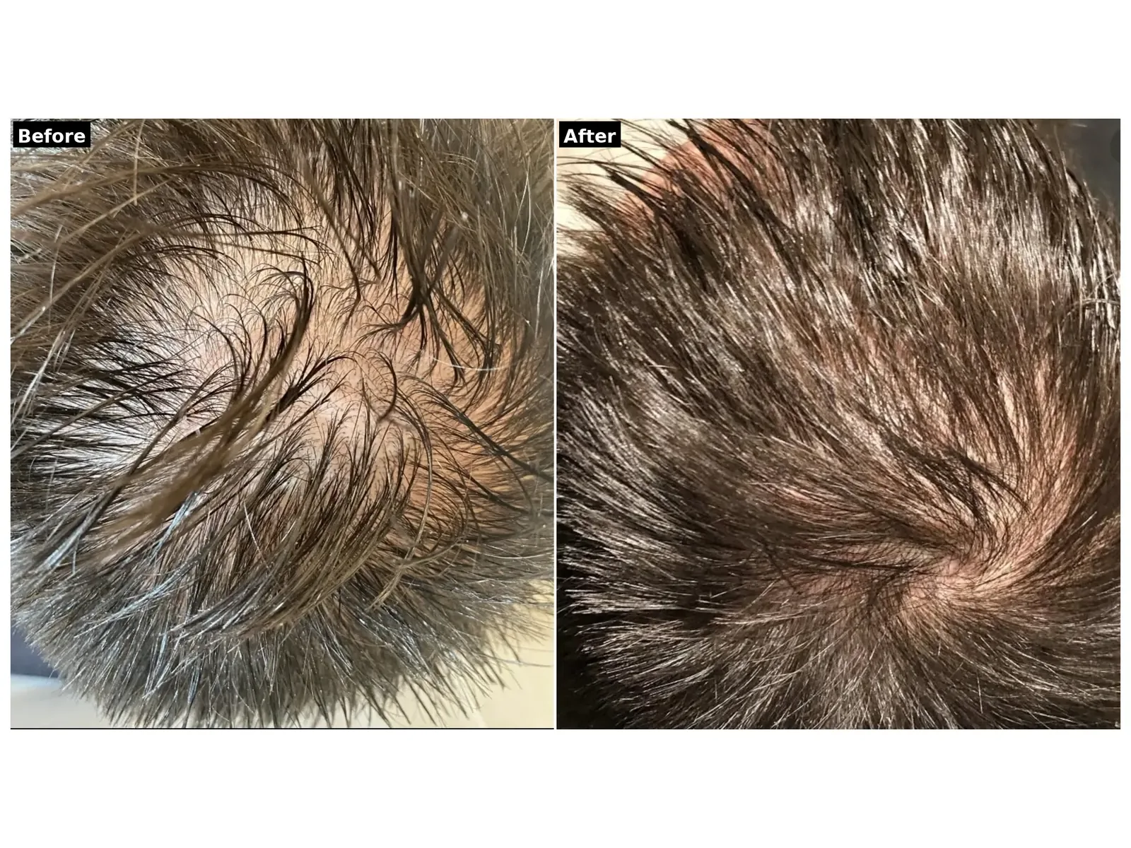 Hair Restoration with PRP