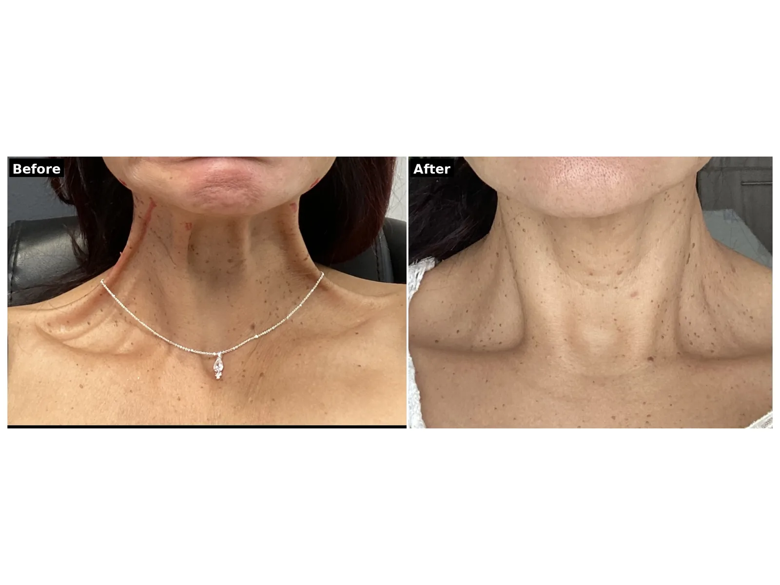 Botox before and after results